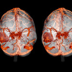 Что выявляет КТ головного мозга